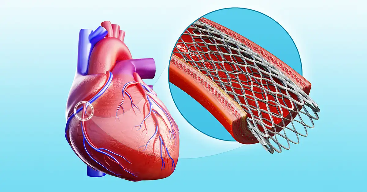 Os stents são uma farsa?